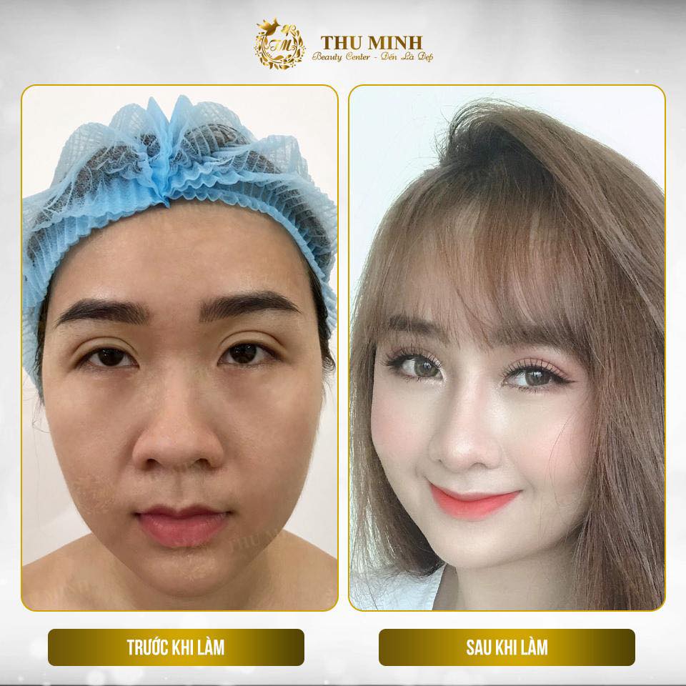 Thu gọn cánh mũi cho dáng mũi thon gọn, đẹp tự nhiên